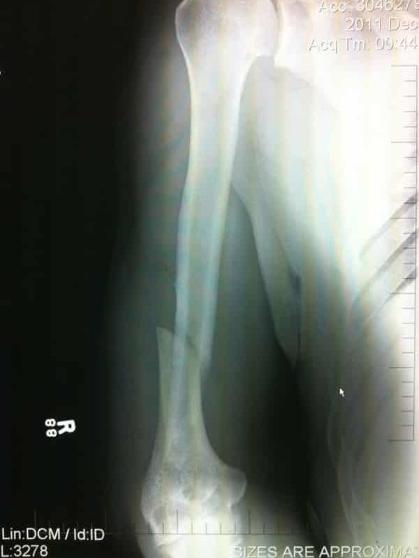 Rayos X del brazo de Antonio Noguiera tras ser roto por una Kimura por parte de Frank Mir en UFC 140 (10.12.11) / Twitter.com/UFC